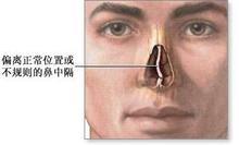 鼻中隔偏曲的原因是什么？怎么治疗鼻中隔偏曲？