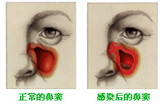 急性鼻窦炎的症状及治疗