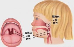 听劝！寒假治疗扁腺肥大，为孩子健康“弯道超车”！