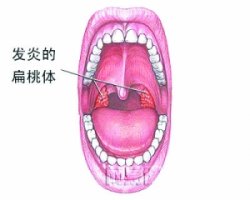 怎么治疗扁桃体炎效果好呢？