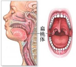 孩子扁桃体肥大要怎么治?