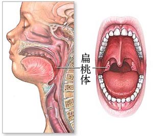 孩子扁桃体肥大要怎么治