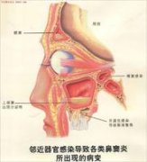 医师全面解析：蝶窦炎需要治疗吗？