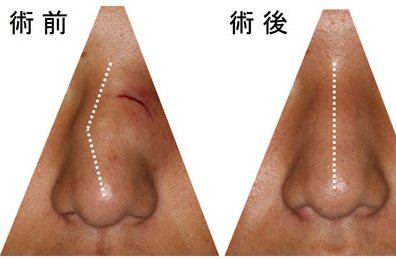 鼻中隔呈c形偏曲怎么治疗?