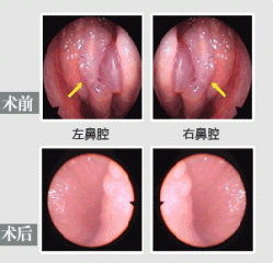 治疗鼻息肉术前术后图片及症状