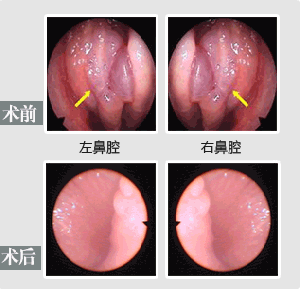 【鼻息肉】鼻内窥镜手术——给鼻息肉诊治