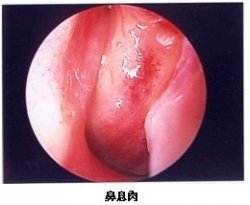 鼻息肉导致20年呼吸不畅