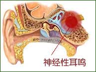 耳鸣的症状，“精英一族”伤不起