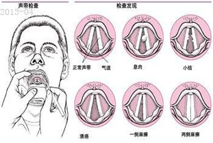 声带充血水肿好难受!该怎么办?