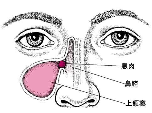 鼻息肉的常见症状