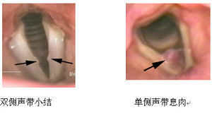 治疗声带息肉也需注意饮食