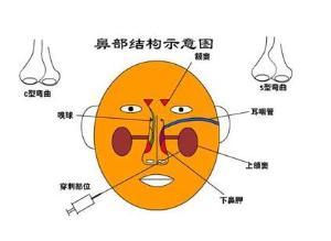 你不可忽视：慢性鼻炎的这些危害