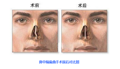 郑州治疗鼻中隔偏曲不错的方法是什么？