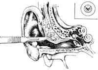 先天性外耳道闭锁是怎么回事？有方法吗？