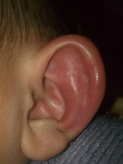 外耳道肿胀怎么办，怎么？
