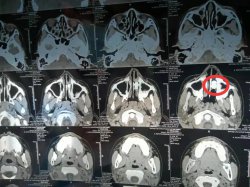 10岁男孩“鼻炎”6个月越治越重，竟是鼻子进了这种东西！