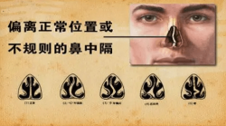 十个里面九个偏！鼻中隔偏曲可是拖不得！