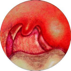 慢性舌扁桃体炎怎么治图片