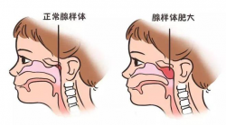 寒假倒计时｜郑州民生耳鼻喉医院核心技术“狙击”鼾症根源，护航儿童健康睡